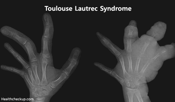 Toulouse Lautrec Syndrome