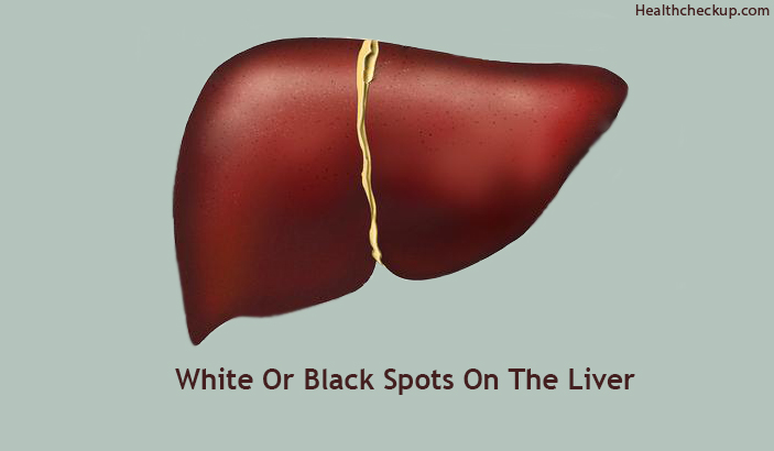 White or Black spots on the liver