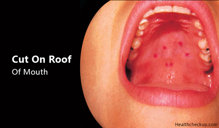 cut on roof of mouth