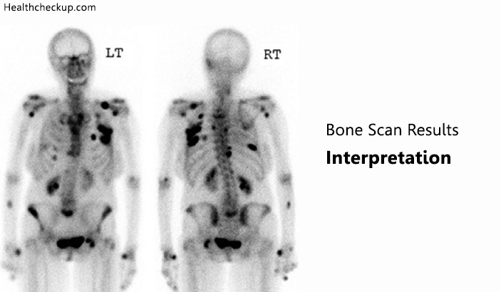 Bone Scan Results Interpretation