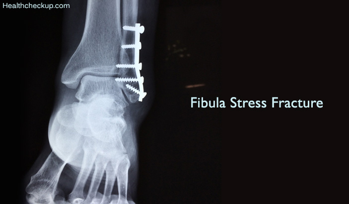Fibula Stress Fracture
