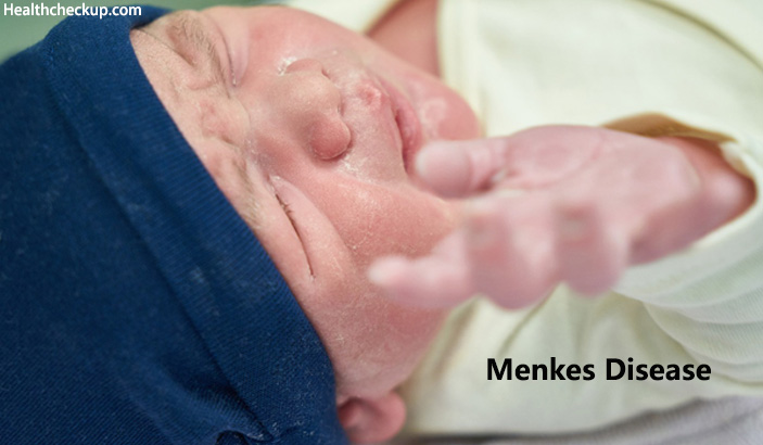 Menkes Disease