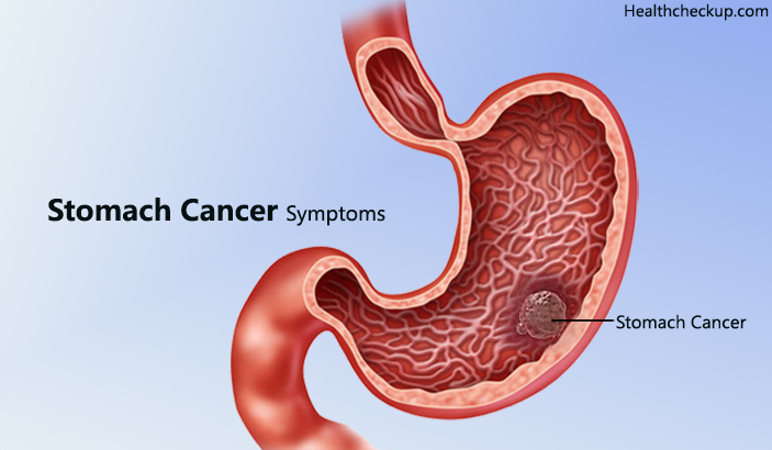 Early Signs and Symptoms of Stomach Cancer