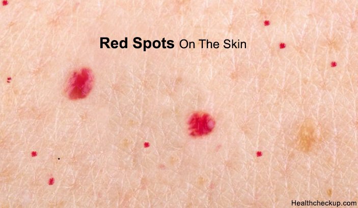 What causes red spots on the skin | How to get rid of the red spots on skin