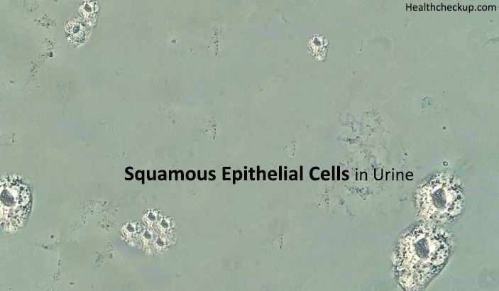 Squamous Epithelial Cells in Urine