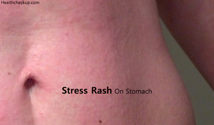 Red Rash Around Belly Button