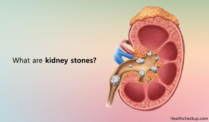 Types of Kidney Stones And Treatment