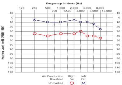 Pure Tone Audiometry Graph 2