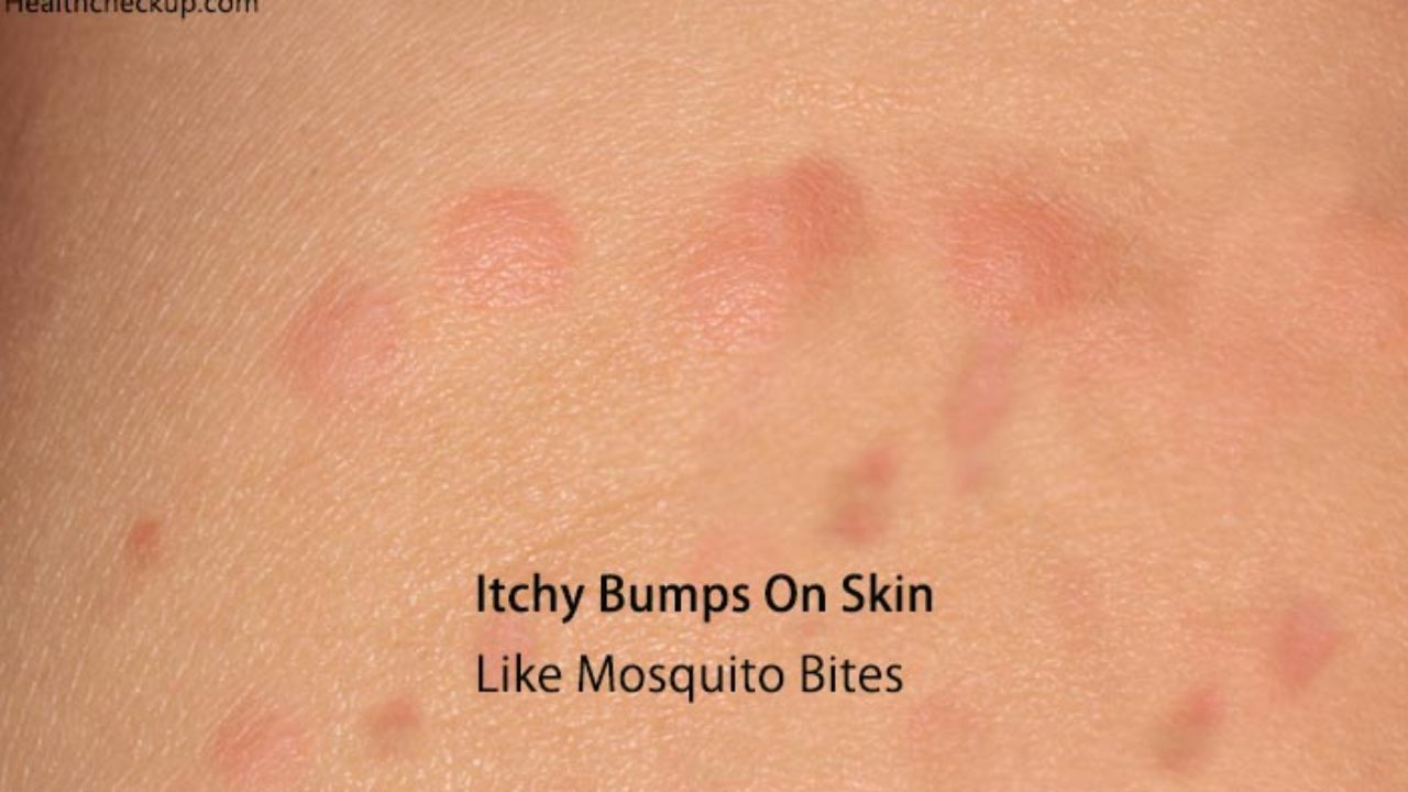 Itchy Bumps On Skin Like Mosquito Bites Sea Lice That Nasty Rash You