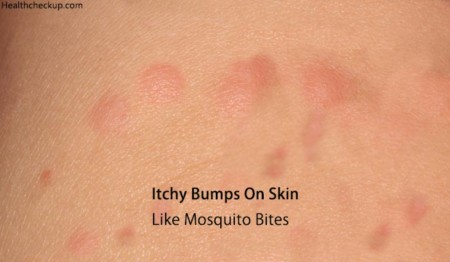 Itchy Bumps On Skin Like Mosquito Bites