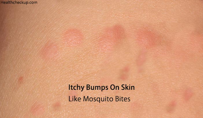 Itchy Bumps On Skin Like Mosquito Bites