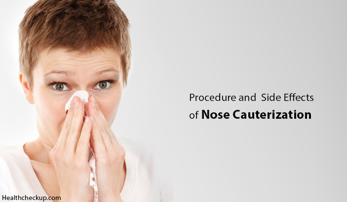 Nose Cauterization Side Effects, Procedue