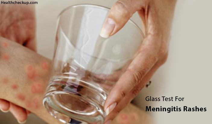 Glass Test For Meningitis Rash