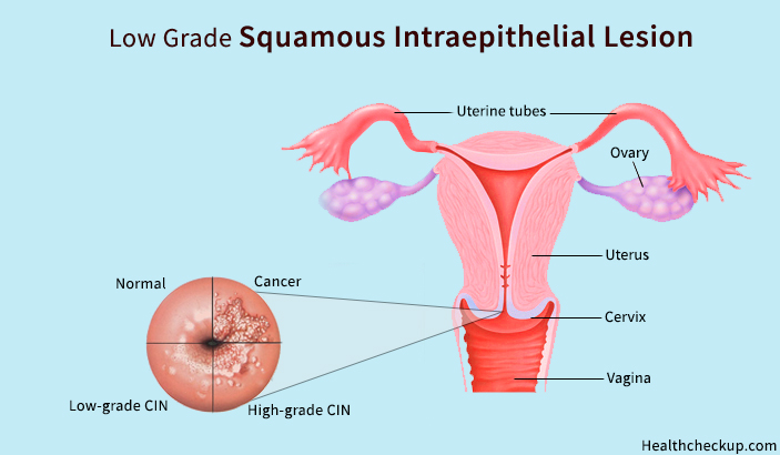 Low Grade Squamous Intraepithelial Lesion Symptoms, Causes, Treatment