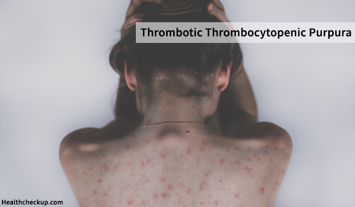 Thrombotic Thrombocytopenic Purpura Symptoms, Causes,Treatment