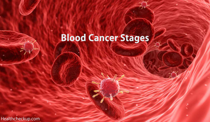 Blood Cancer Stages