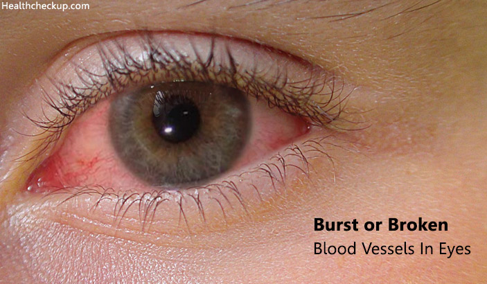 Burst or Broken Blood Vessels in Eyes