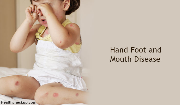 Hand Foot and Mouth disease