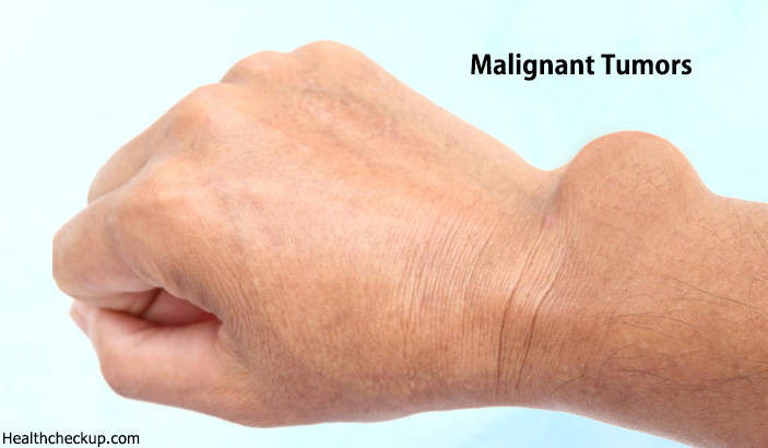 Malignant Tumor Symptoms, Causes, Diagnosis, Treatment