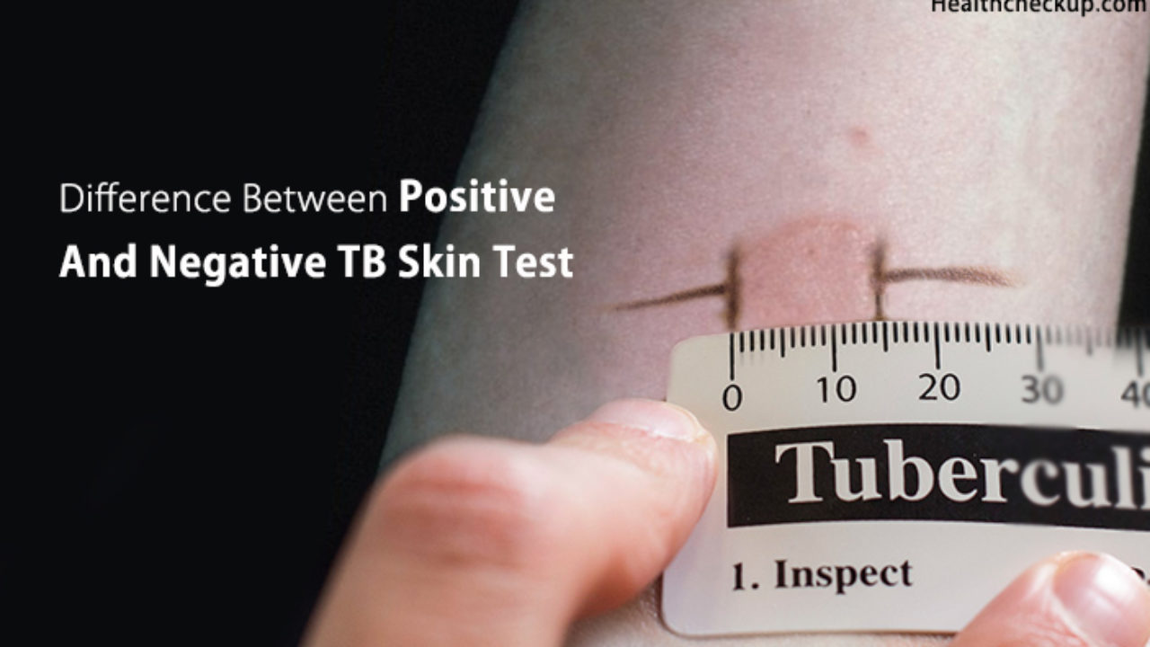 normal negative tb test pictures