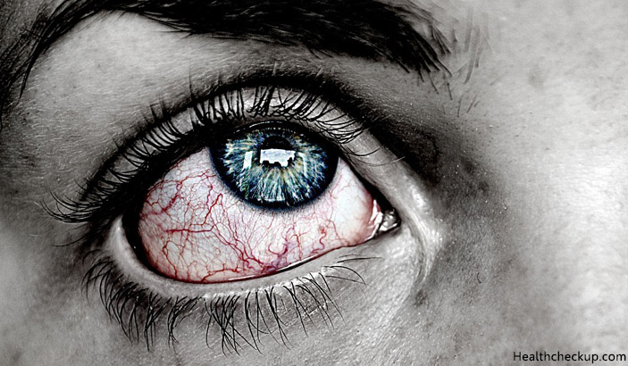 Picture of Broken Blood Vessels in Eye