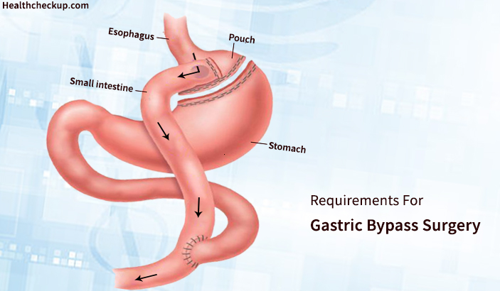 equirements For Gastric Bypass Surgery