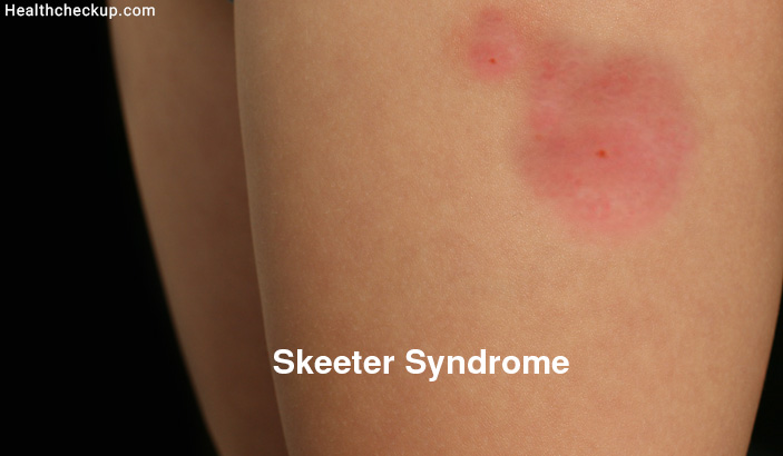 Skeeter Syndrome Treatment, Symptoms, Causes, Recovery Time