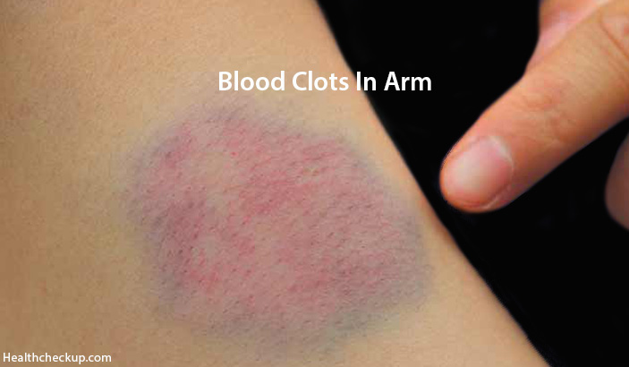 Blood Clot in Arm Symptoms, Causes, Diagnosis, Treatment