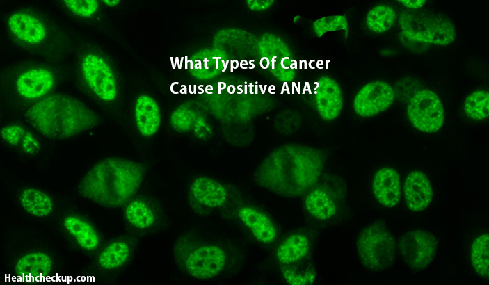 What types of cancer cause positive ana