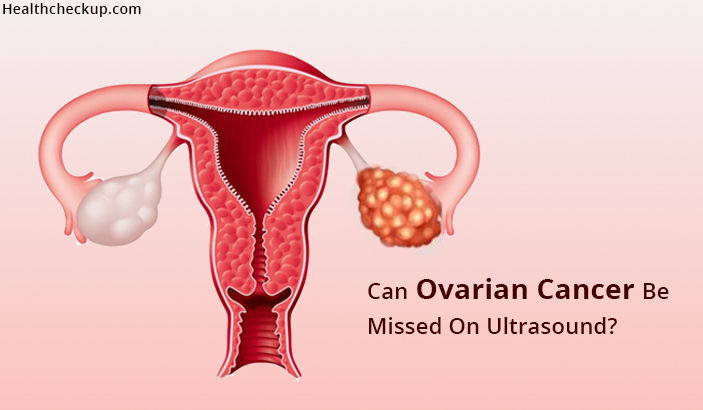 Can Ovarian Cancer Be Missed On Ultrasound