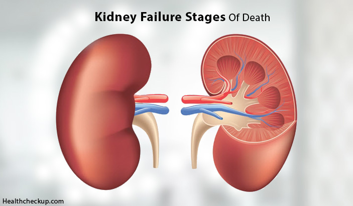 What Are The Kidney Failure Stages of Death - Health Checkup