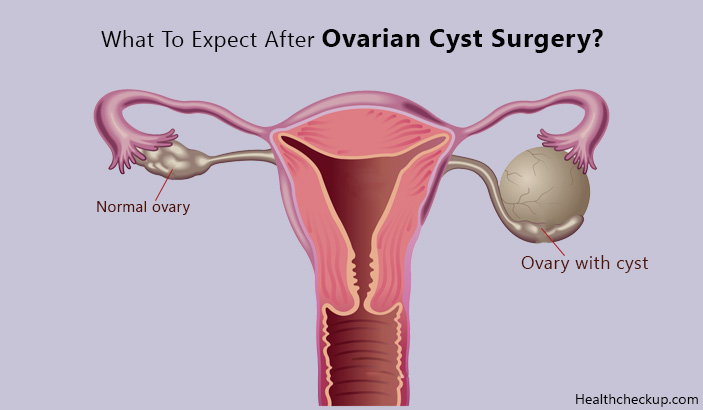 What to Expect After Ovarian Cyst Surgery?