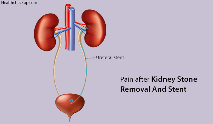 pain after kidney stone removal and stent