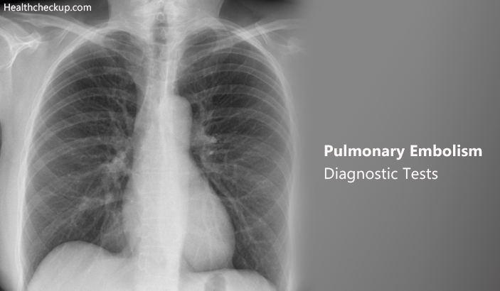 Pulmonary Embolism Diagnostic Tests, Preparation, Procedure, Results