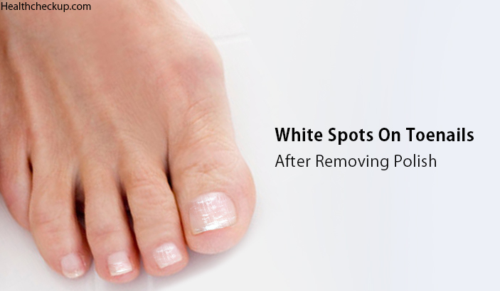 White Spots On Toenails After Removing Polish - Causes, Treatment, Home  Remedies