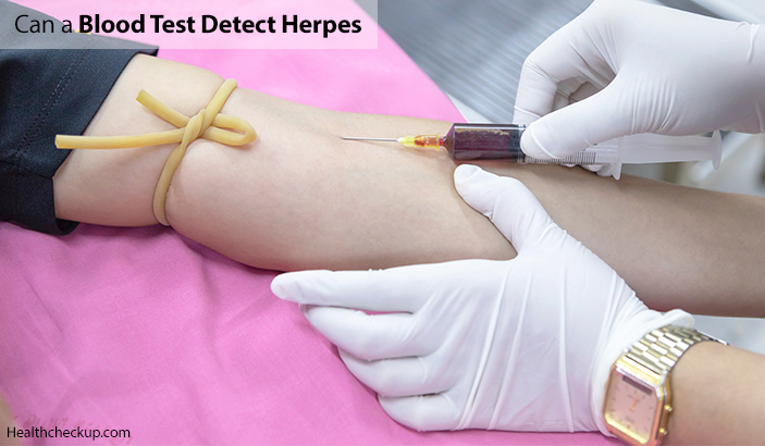 Can A Blood Test Detect Herpes
