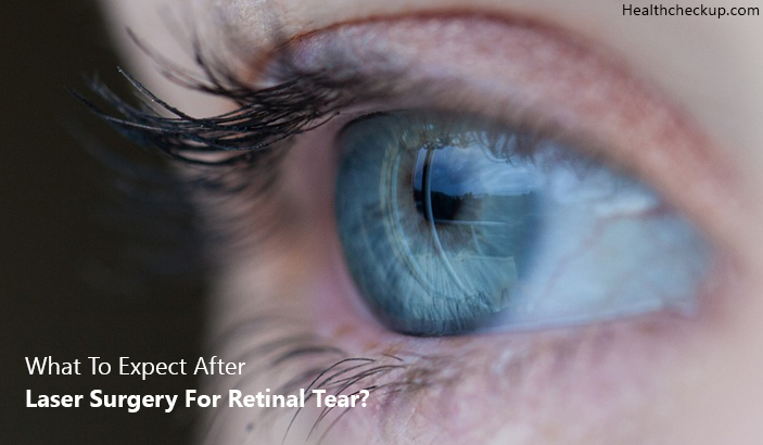 What To Expect After Laser Surgery For Retinal Tear