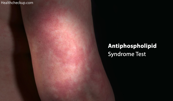 Antiphospholipid Syndrome Test - Prep, Procedure, Results, Duration