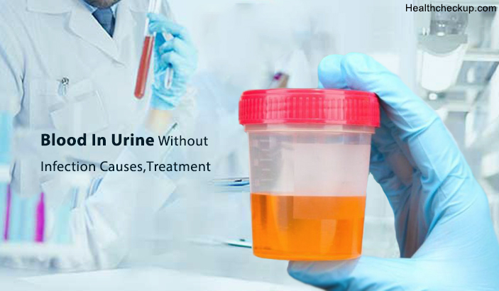 What Can Cause Blood in Urine Without Infection