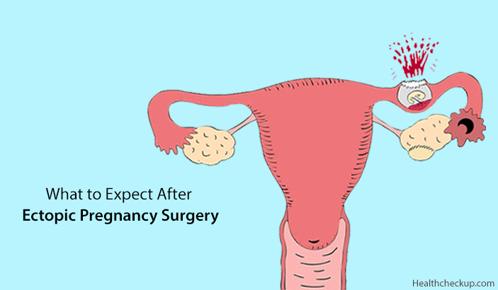 what to expect after ectopic pregnancy surgery