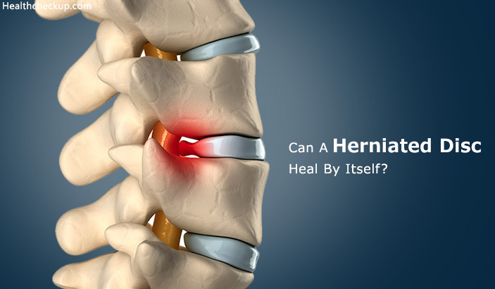 Can a herniated disc heal by itself?