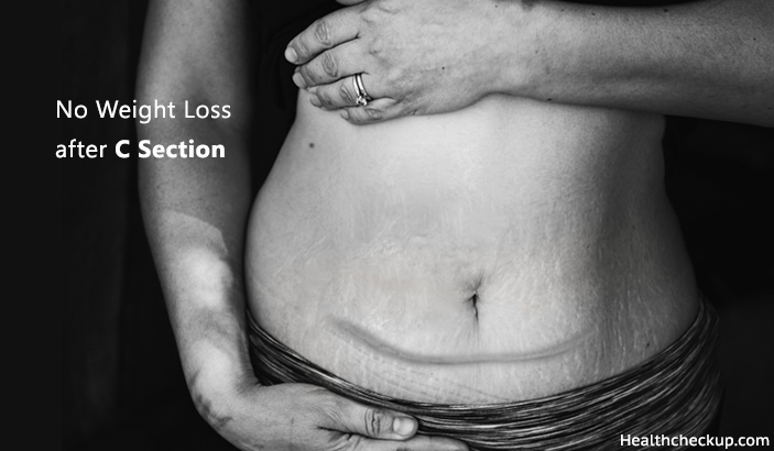 Not Losing Weight After C-section - Causes, Treatment