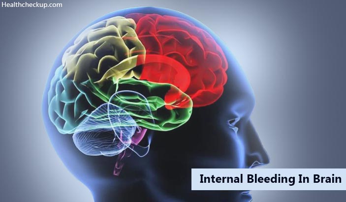 Internal Bleeding in Brain Symptoms, Causes, Diagnosis, Treatment