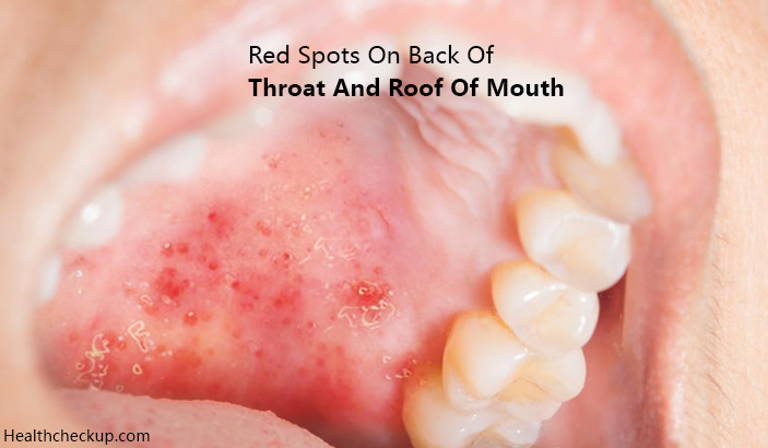 Red Spots on Back of Throat and Roof of Mouth Causes, Diagnosis, Treatment by Dr Himanshi