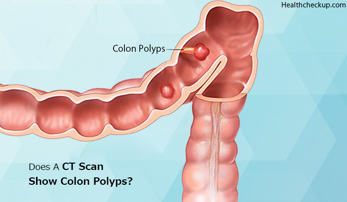 Does a ct scan show colon polyps?