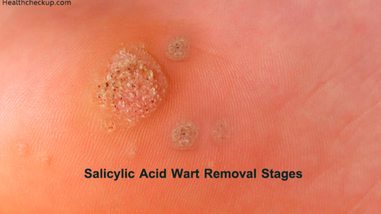 salicylic acid plantar warts