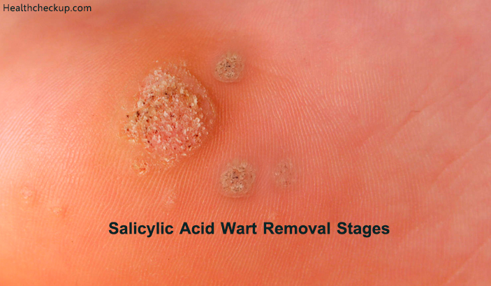 Stages of Wart Removal Using Salicylic Acid | Wart Removal at Home