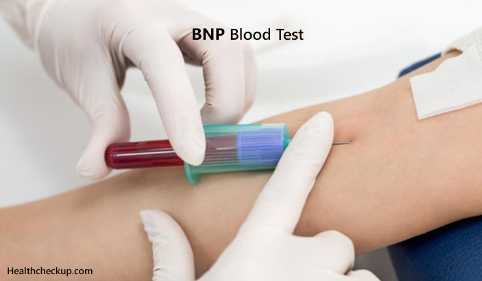 BNP Blood Test