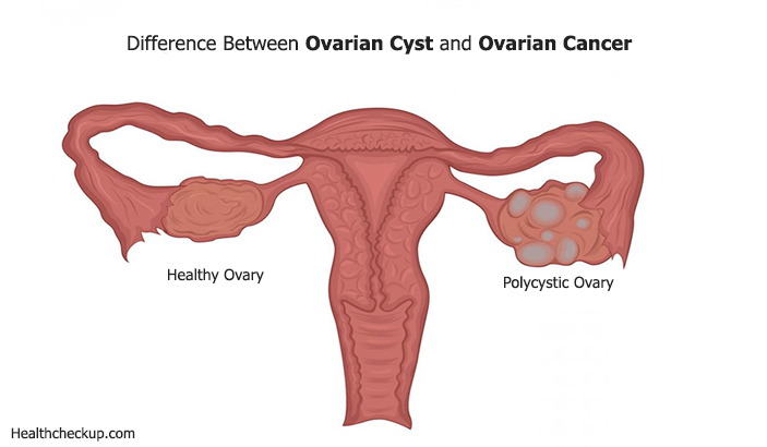 Difference Between Ovarian Cyst And Ovarian Cancer