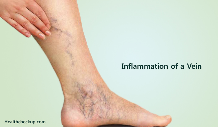 Inflammation of a Vein